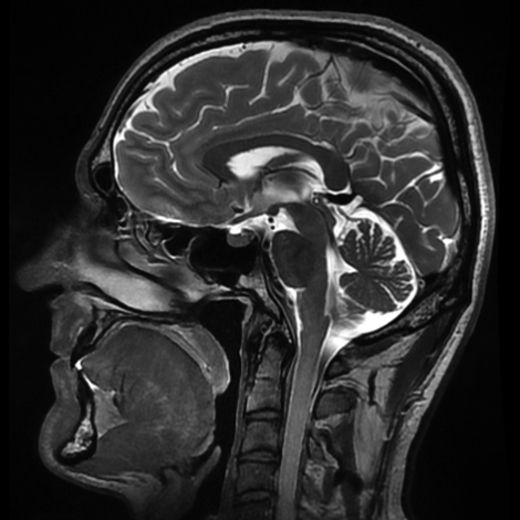 collapsing mind impakt 