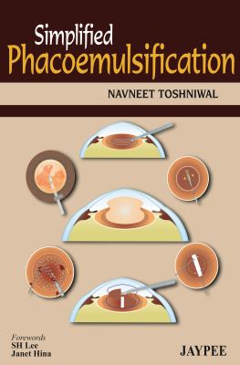 Simplified Phacoemulsification Toshniwal Navneet 